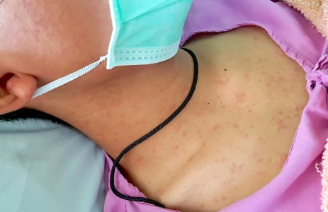 麻疹与德国麻疹有什么不同？ 麻疹传染性极强，9 大症状要留意；接种疫苗可有效预防
