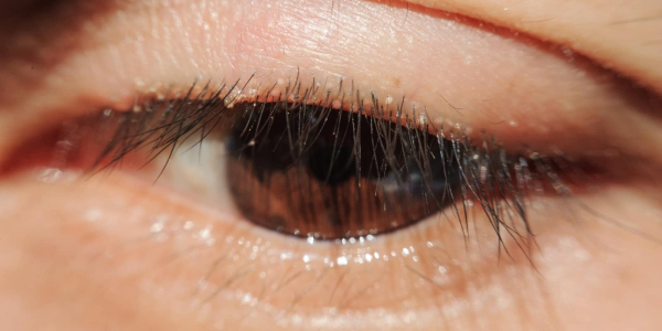 what-is-blepharitis