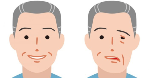 中风常见6大后遗症：瘫痪、失语与认知障碍，复健护理不容忽视