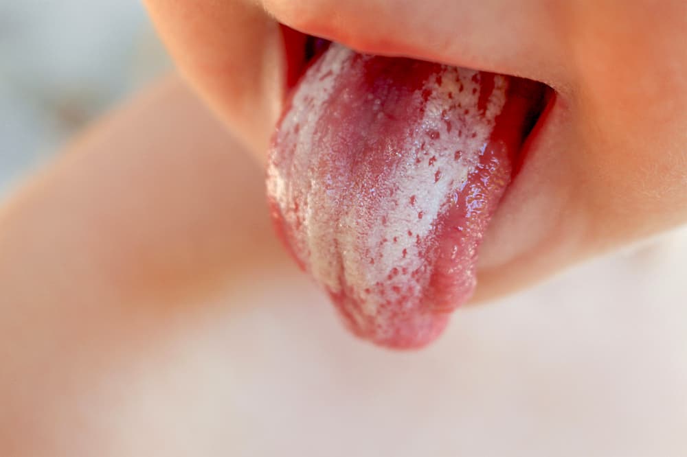 哺乳期念珠菌感染：妈妈与宝宝都需小心防范