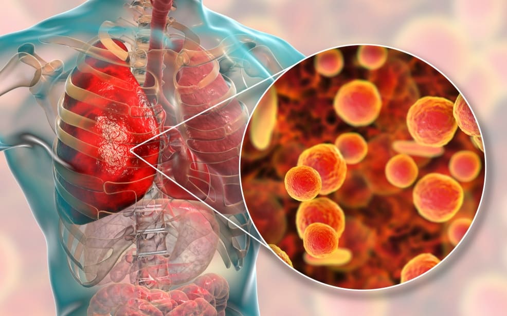 understanding-walking-pneumonia