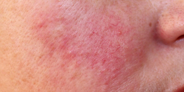 脸上有蠕形螨虫怎么办？蠕形螨虫的症状、原因、治疗药膏公开