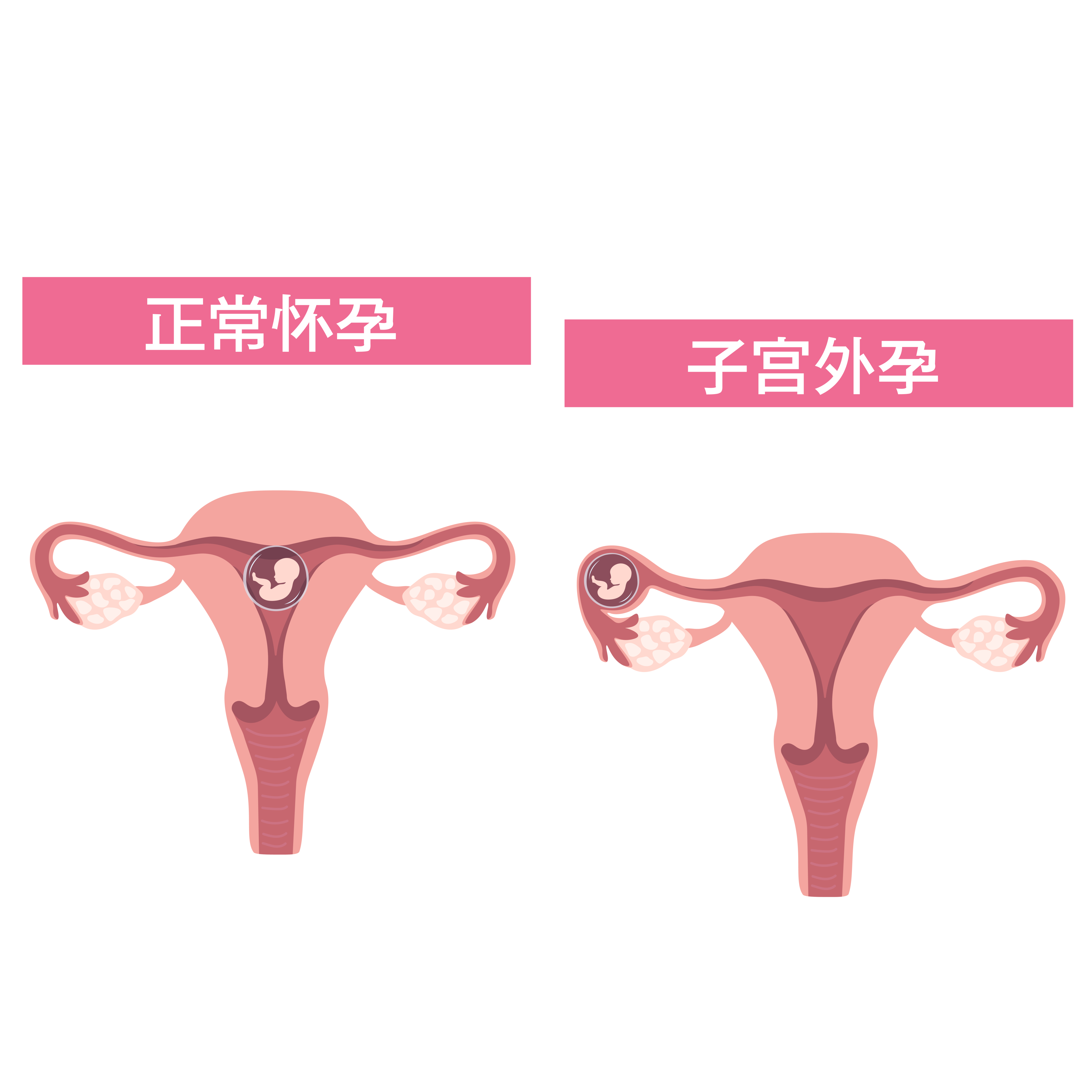 腹痛可能与子宫外孕有关：认识子宫外孕的诊断与治疗