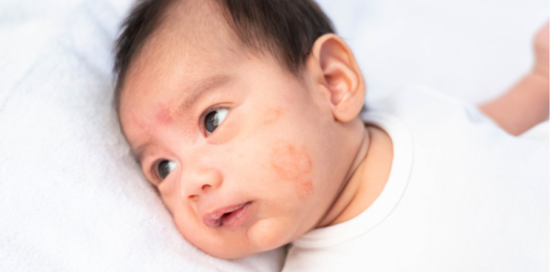 宝宝的异位性皮肤炎可以改善吗？原因、症状与治疗方式解析