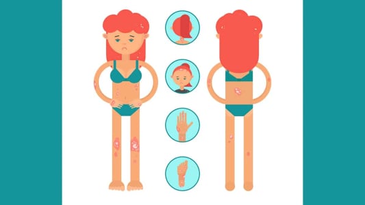 干癣管理的8项实用建议：帮助稳定病情、降低复发