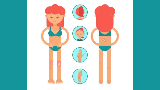 understanding-and-managing-psoriasis-triggers
