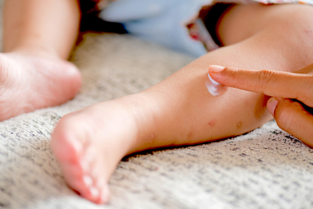 clinical-management-of-friction-blisters