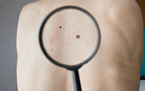 是痣还是肿瘤？认识黑色素瘤的类型、症状与治疗方式