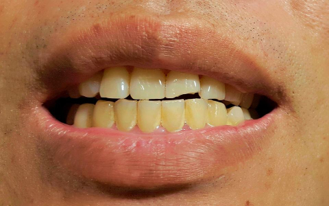 surprising-causes-of-tooth-stains