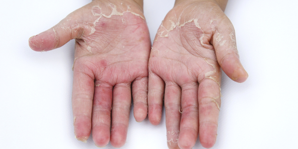 home-remedies-to-help-manage-hand-eczema
