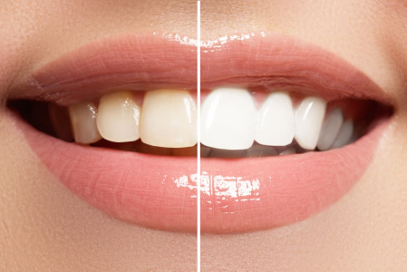 how-to-naturally-lighten-teeth-at-home