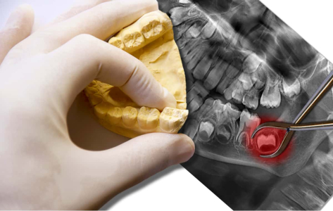 understanding-when-wisdom-teeth-should-be-removed