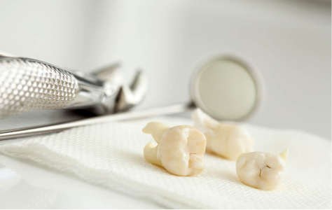 understanding-wisdom-teeth-and-their-impact