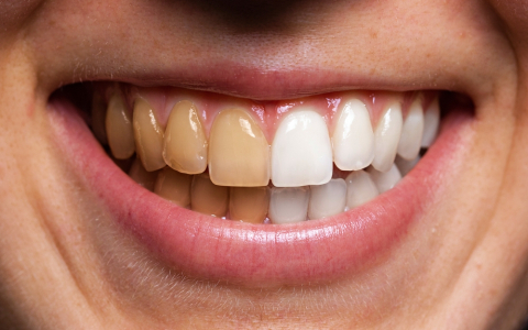what-foods-and-habits-can-discolor-your-teeth
