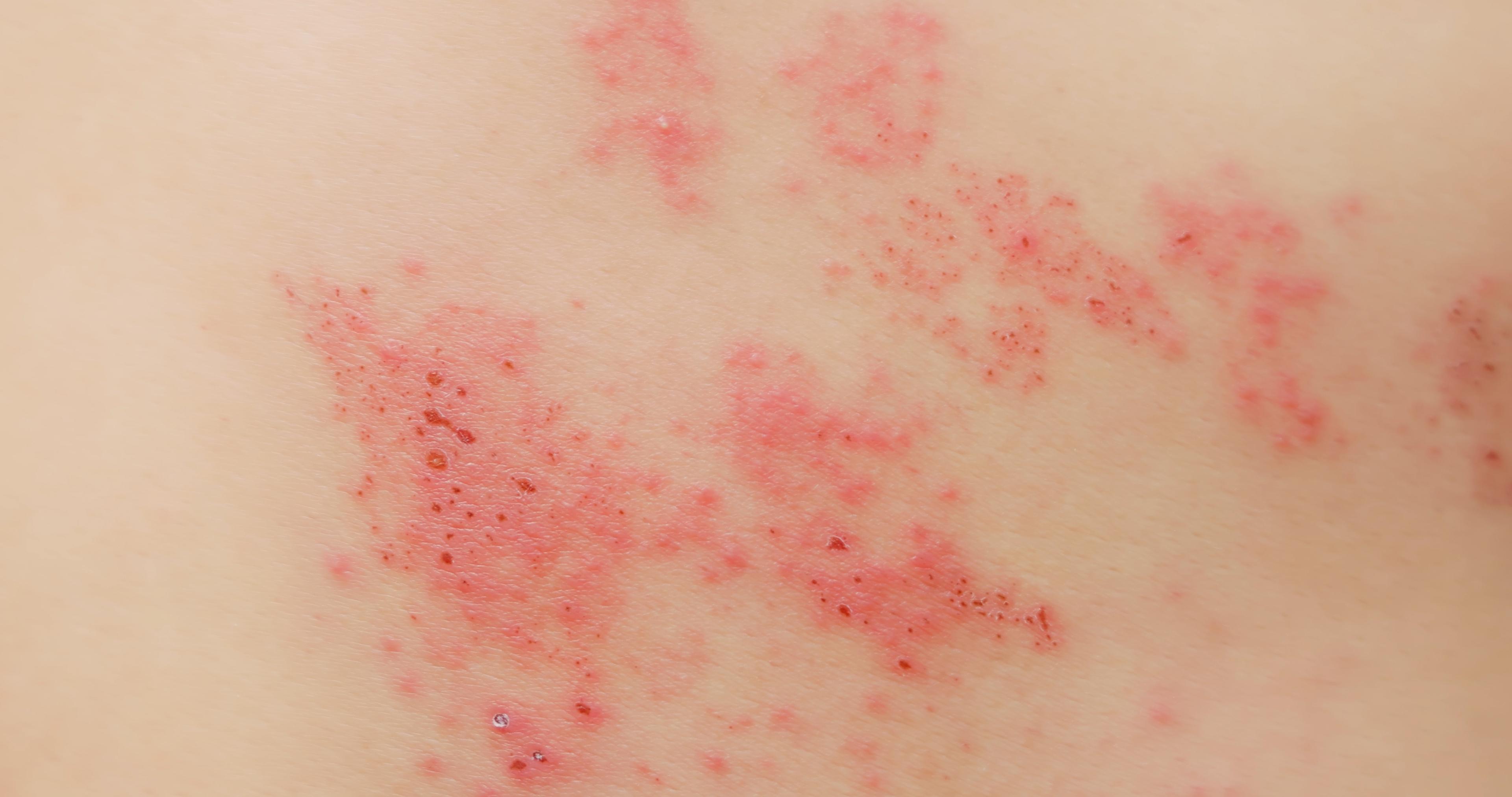 shingles-herpes-zoster-guide